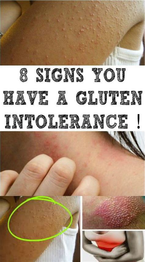 Signs You Have A Gluten Intolerance
