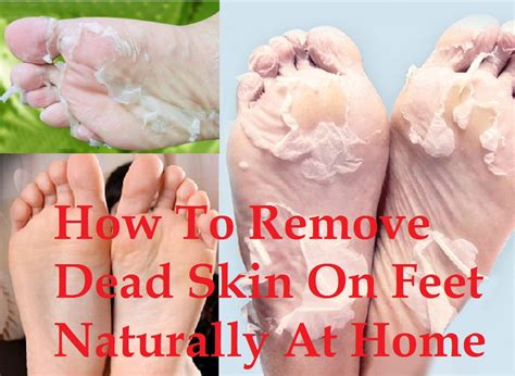 How To Remove Dead Skin On Feet Naturally At Home Trends 2024