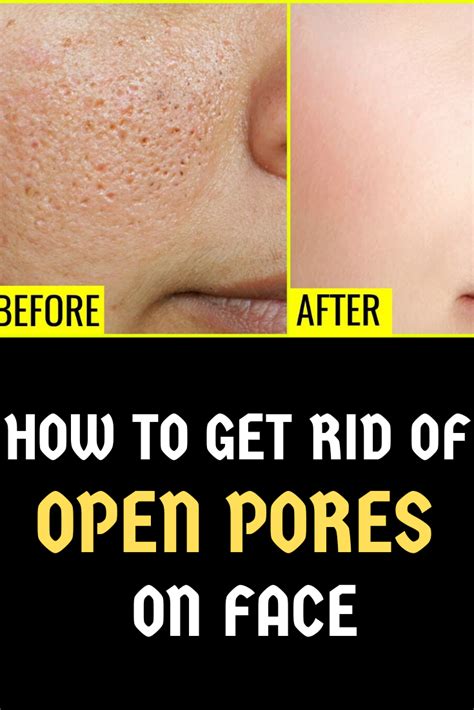 How To Get Rid Of Open Pores On Face Open Pores On Face Face Pores