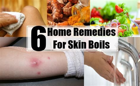 Home Remedies For Skin Boils Natural Treatments Cure Diet For Skin