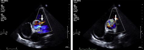 Infective Endocarditis Of The Aortic Valve Complicated By AortaTo