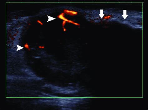 Ultrasound Of The Groins Showing Enlarged Inguinal Lymph Nodes With