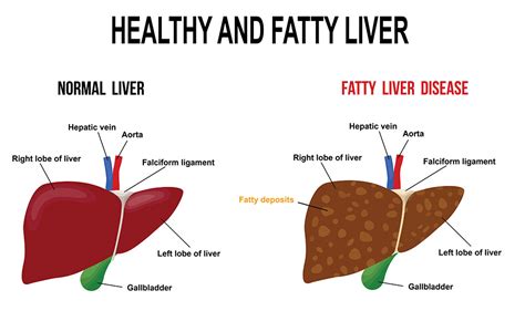 Symptoms Of Cirrhosis Fatty Liver Remedy