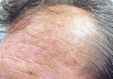 Skin Cancer Actinic Keratosis Pictures