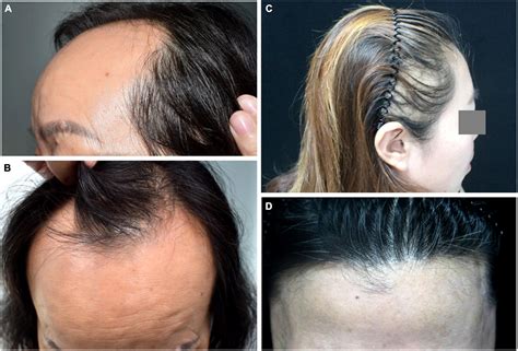 Frontal Fibrosing Alopecia An Update On Pathogenesis Diagnosis And My