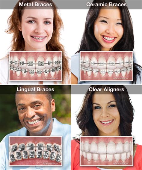 How Much Are Braces How Much Does Braces Cost Orthodontic Treatment
