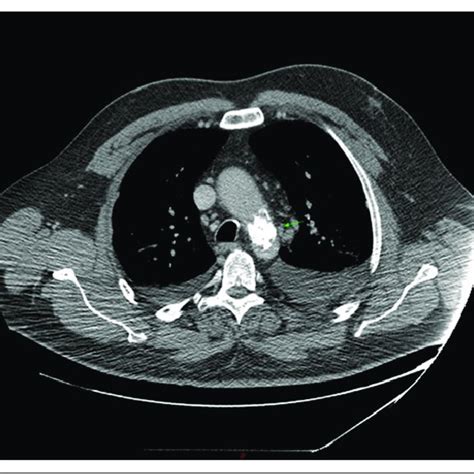 Calcified Aortic Lesion Near Aortic Arch By Computed Tomography