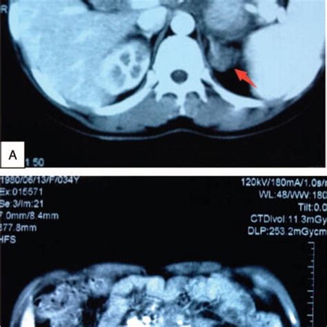 Contrast Enhanced Computed Tomography Of Abdomen Reveals 2 Conspicuous