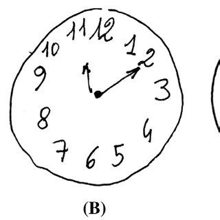 In this clock drawing task, the subject is asked to draw a clock with the hours and showing the. Moca Scoring Nuances With Clock Draw / Montreal Cognitive ...