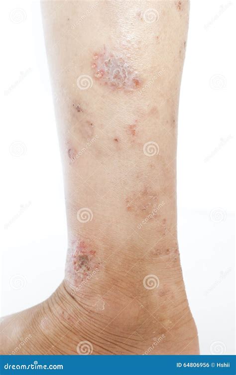 Eczema On Leg Stock Photo Image Of Rash Flaky Cracked 64806956