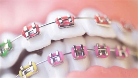 Braces Cost In North Sydney