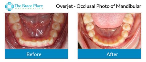Occlusal Photo Of Mandibular The Brace Place Orthodontics