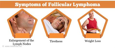 Follicular Lymphoma Causes Symptoms Diagnosis Treatment And Prevention