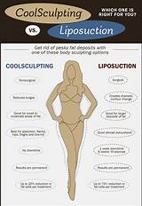 Coolsculpting Side Effects Long Term Pictures