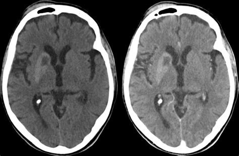 Ct Hyperdense Lesion After Head Trauma Is It Traumatic Bmj Case Reports