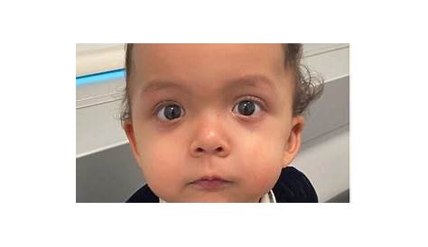 A Rare Mutation in Noonan Syndrome