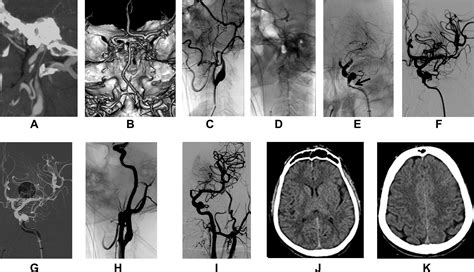 Emergency Endovascular Revascularization Of Tandem Occlusions Internal