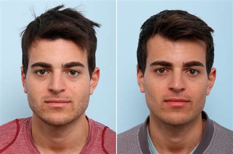 Male Cosmetic Surgery Photos Houston Tx Patient 57941
