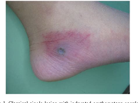 Figure 1 From Disseminated Fusarium Infection In A Patient With Acute
