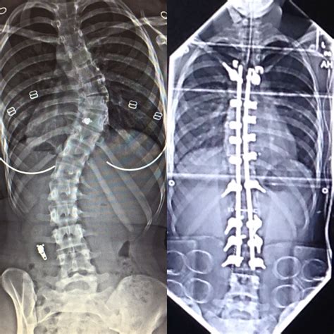 My Journey With Scoliosis Caseys Story