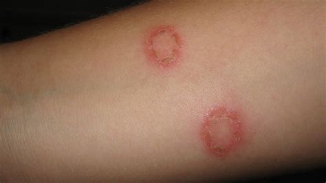 Ringworm Treat Naturally With Neem Oil Justneem