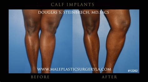 Calf Implants Gallery Of La Patients Male Plastic Surgery Los Angeles