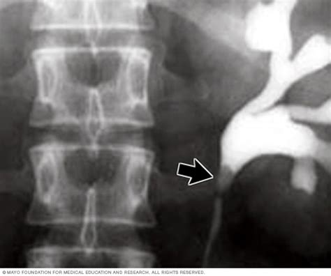 X Ray Image Of Kidney Stone Mayo Clinic