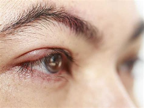 What Causes Rashes On Eyelids