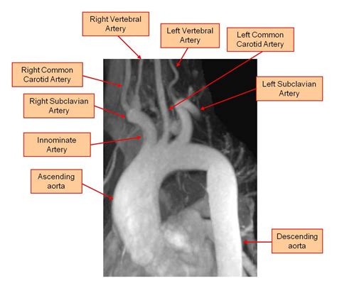 The Aorta And Its Major Branches Central Sydney Cardiology Academic