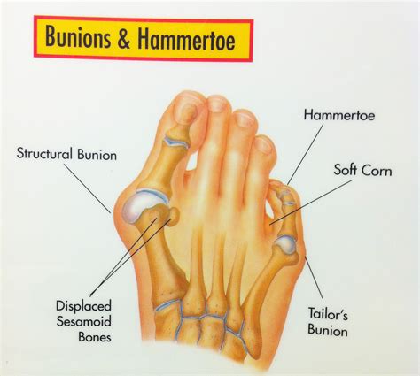 Foot Anatomy Bunion