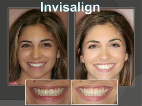 Dentist Orlando Florida Invisalign Invisalign Perfect Smile