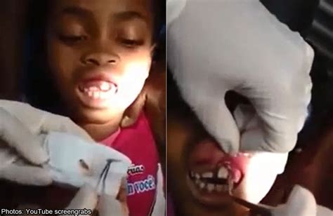 Maggots Found After Girl Complains Of Tingling In Gums World News Asiaone