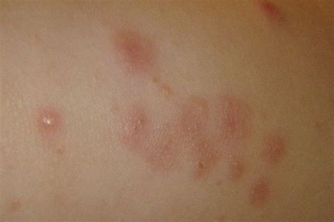 Diffuse Erythematous Papules Clinical Advisor