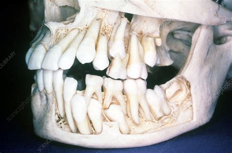 Human Teeth Skull