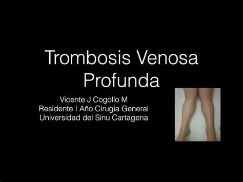 Pdf Trombosis Venosa Profunda Aguda Dokumen Tips The Best Porn Website