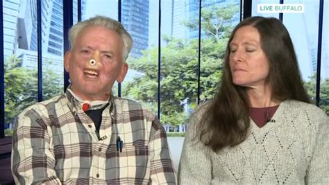 Man Whose Face Was Ripped Off By A Bear Reveals On This Morning Hes Growing A New Noseon His