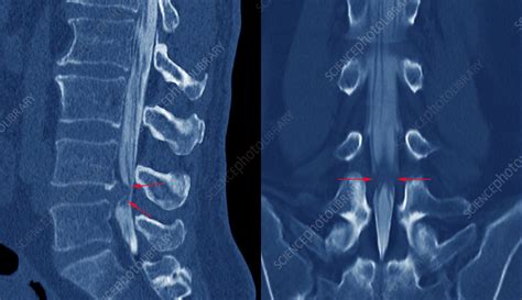 Slipped Disc Ct Scans Stock Image M3301497 Science Photo Library