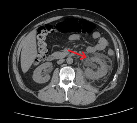 Abdominal Ct In Axial Plane Showing At The Point Indicated By The