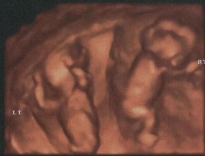 If you have not yet had any type of pregnancy ultrasound and you are around 12 weeks pregnant, your maternity care provider may suggest you have one. 4D Twins Ultrasound - 12 Weeks 5 Days