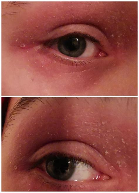 Had Dry Flaky Skin Around Eyes For 8 Months Tried Moisturiser