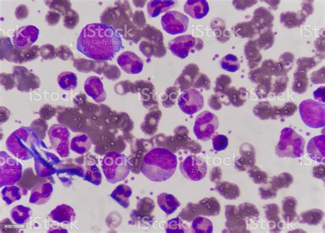 Blast Cells In Leukemia Stock Photo Download Image Now Istock
