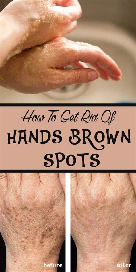 How To Get Rid Of Hands Brown Spots In 2020 Brown Spots On Hands