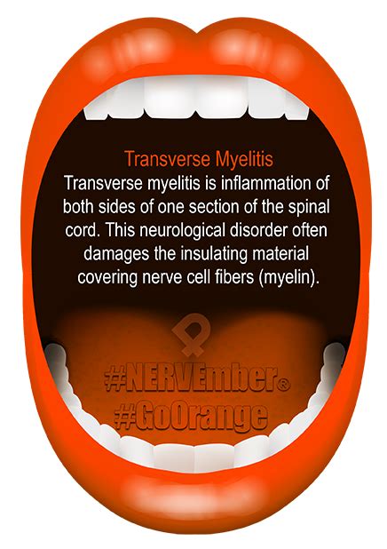 Learn all about transverse myelitis, including its symptoms, diagnosis, and treatment, as well as its interesting connection to multiple sclerosis. Transverse Myelitis NERVEmber GoOrange iPain - iPain ...