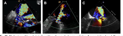 Figure 12 From Mitral Prosthetic Valve Assessment By Echocardiographic