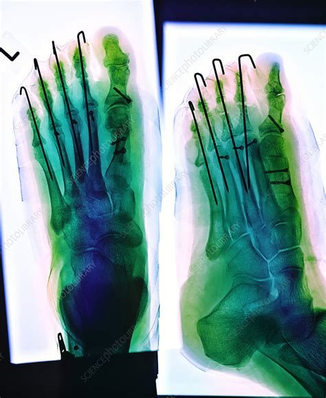 Pinned Foot X Ray Stock Image M3301669 Science Photo Library