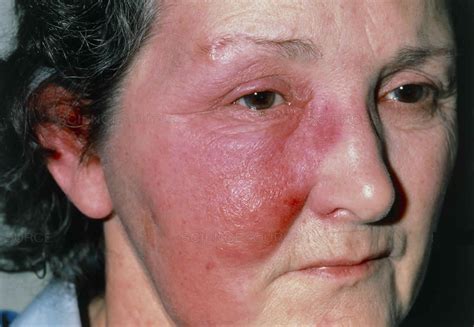 Erysipelas Causes Erysipelas Symptoms And Erysipelas Treatment
