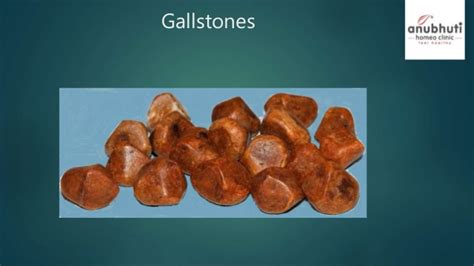 I am sure that a new method of finding remedy in homeopathy has to be invented can we dissolve gall bladder stones with homeopathy? Gallstone gallbladder homeopathy treatment by anubhuti ...