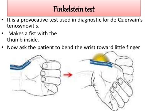Treatment is generally conservative with thumb spica braces, injections and in refractory cases, 1st. De Quervain's Tenosynovitis : Causes,Symptoms,Diagnosis ...