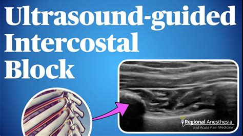 Ultrasound Guided Intercostal Nerve Block Youtube