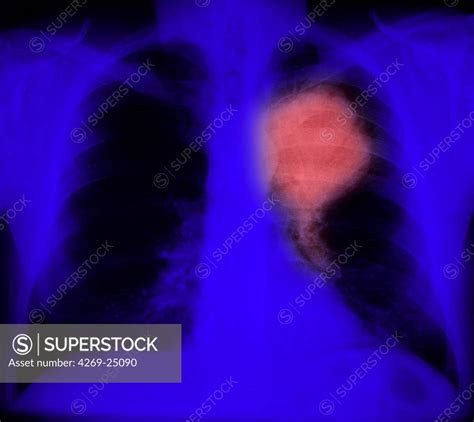 Small Cell Lung Cancer Chest X Ray My Xxx Hot Girl